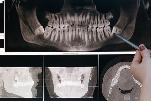 Jaw Coupling types and classifications - Comparison: Standard L-Type vs Zero-Backlash vs Spacer Jaw