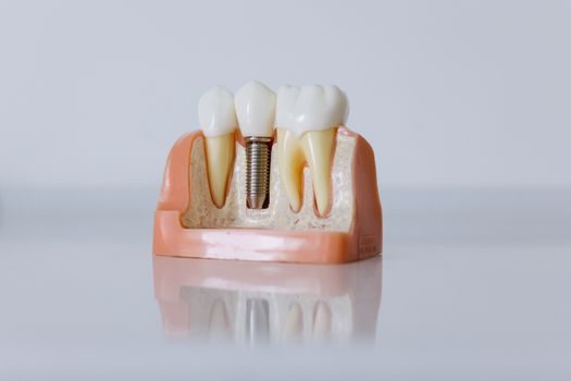 Zirconia Ceramic advantages and disadvantages - Comparison at a Glance: Zirconia vs Alumina vs Silicon Carbide