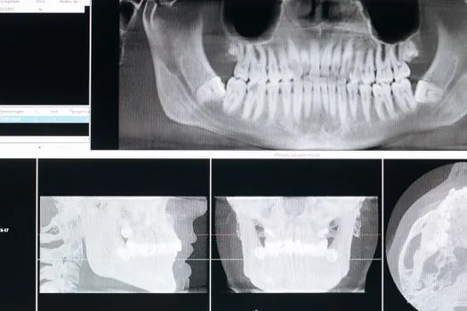 asme section v article 2 radiographic examination requirement - Acceptance standards: where Article 2 ends and the referencing code begins