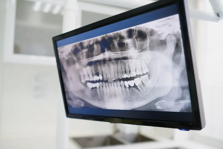 Film vs Digital Radiography: Per-Exposure Cost and Chemistry Stack
