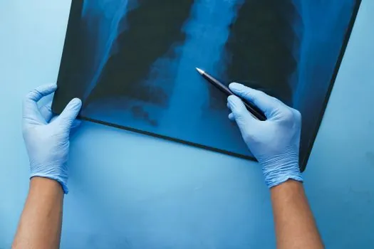 can an industrial X-ray system inspect composites and plastics at low kV? - 2D radiography vs CT vs alternatives for the same low-Z part